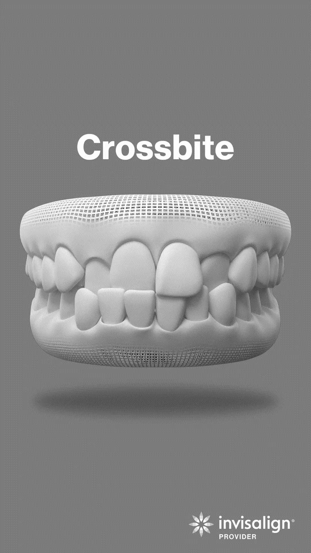 Cross bite - Correcting abnormal teeth alignment.