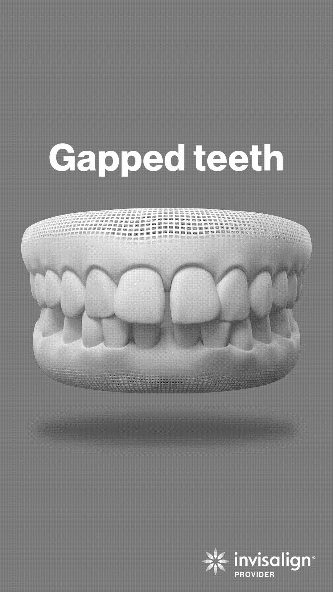 Gapped teeth - Closing gaps between teeth.