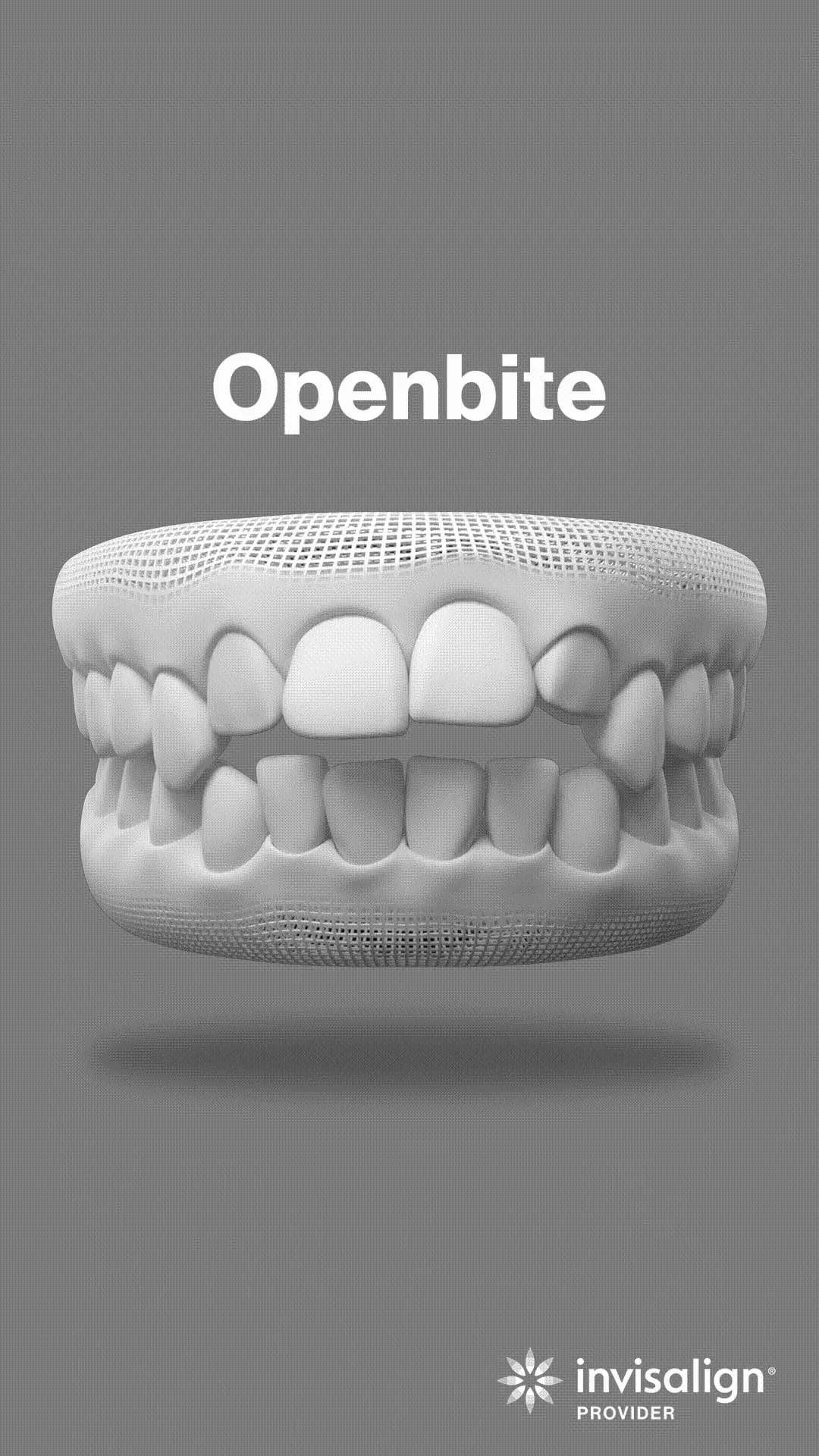 Open bite - Correcting open bite for better occlusion.