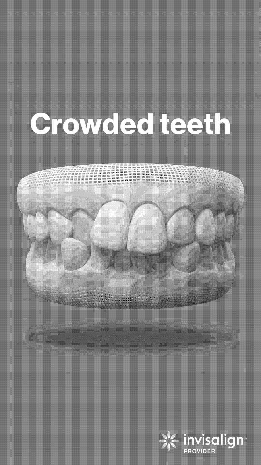 Crowded teeth - Aligning teeth in limited space.