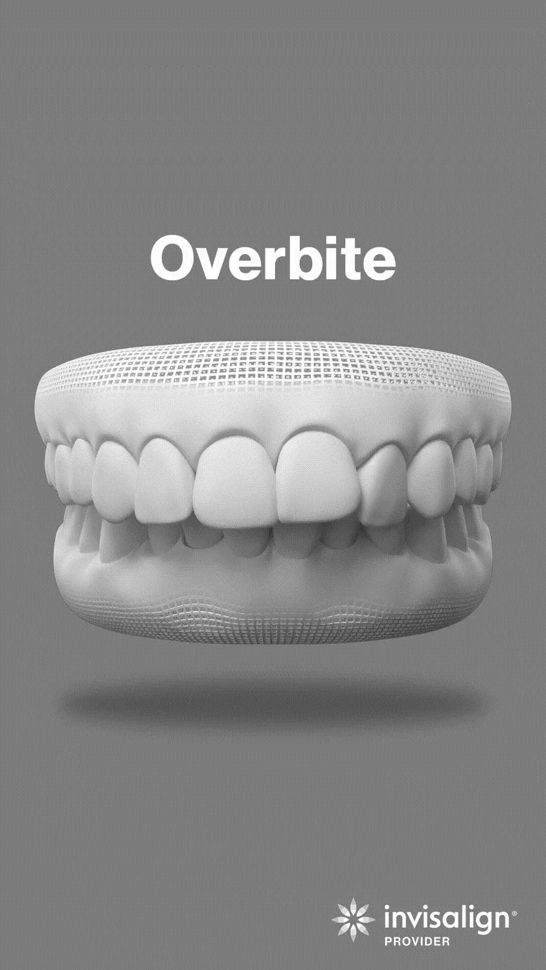 Overbite - Aligning teeth with overbite.