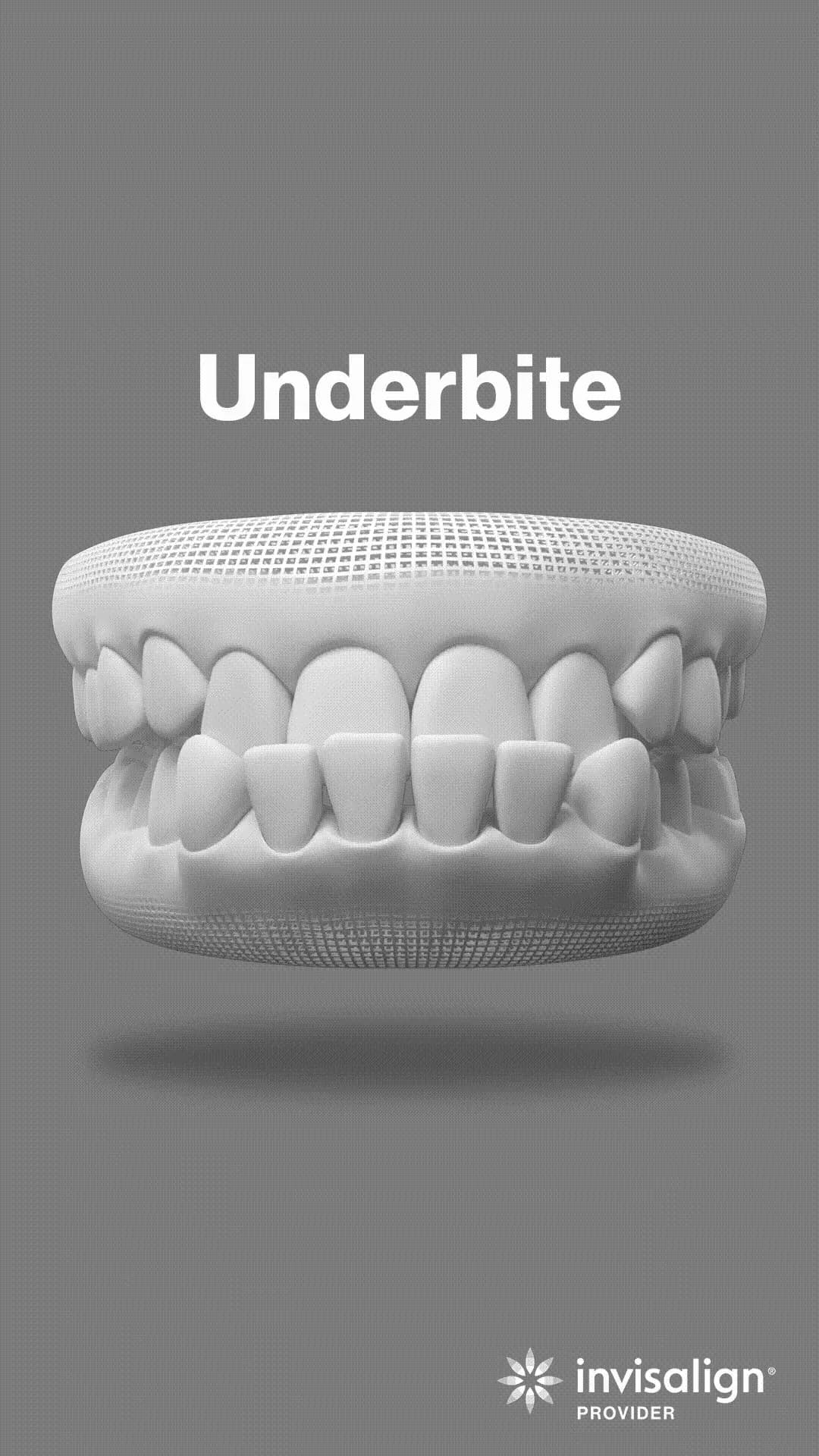 Underbite - Correcting underbite for teeth alignment.